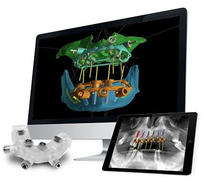 image3dconversion i3d CBCT to STL DICOM to STL computer guided surgery Dental Implant Restorative dentistry Full mouth Reconstruction Digital Dentistry Implant Planning Guided Implant Surgery Guided Surgery Planning
